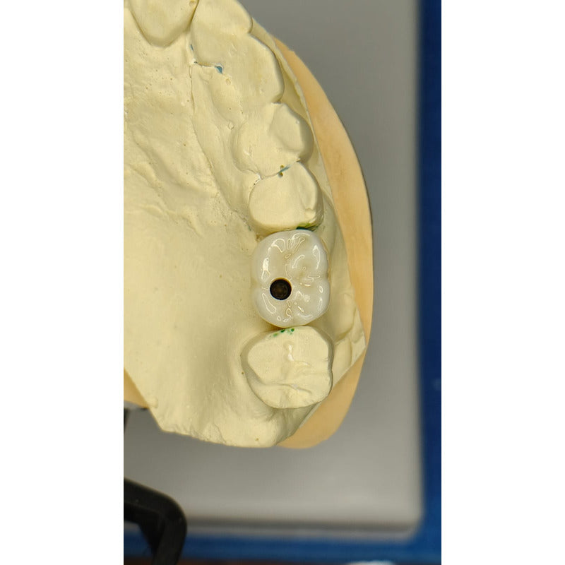 Corona Zirconia